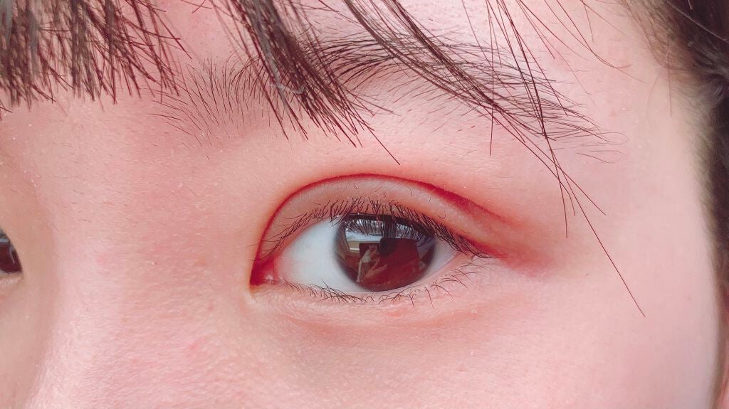 いちご on LIPS 「二重切開から7日目、抜糸してきました!病院に着くとすぐ呼ばれた..」(1枚目)