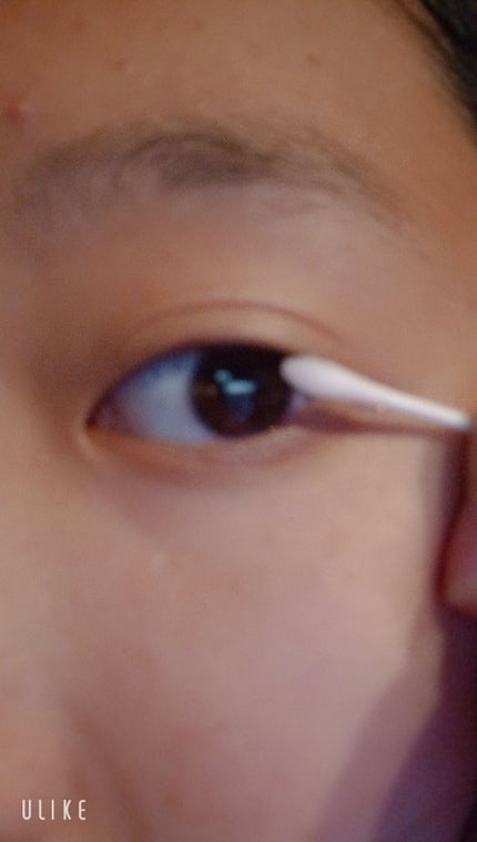 ニキビ治療薬(医薬品)/メンソレータム アクネス/その他を使ったクチコミ(7枚目)