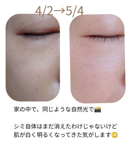 ホワイトCクリア(医薬品)/トランシーノ/その他を使ったクチコミ(2枚目)