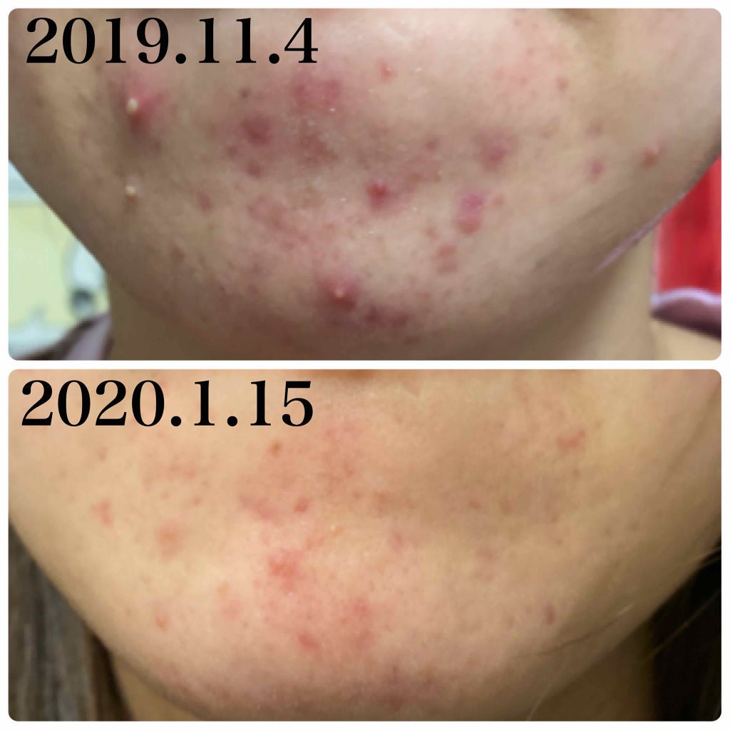 7 day Special Set プログラム3/b.glen/トライアルキットを使ったクチコミ(2枚目)