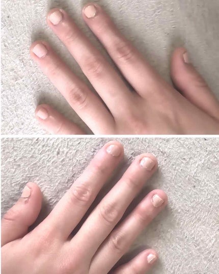 ぬこちゃん on LIPS 「⚠️写真2枚目かなりひどい深爪画像なのでグロ注意です⚠️[深爪..」(2枚目)