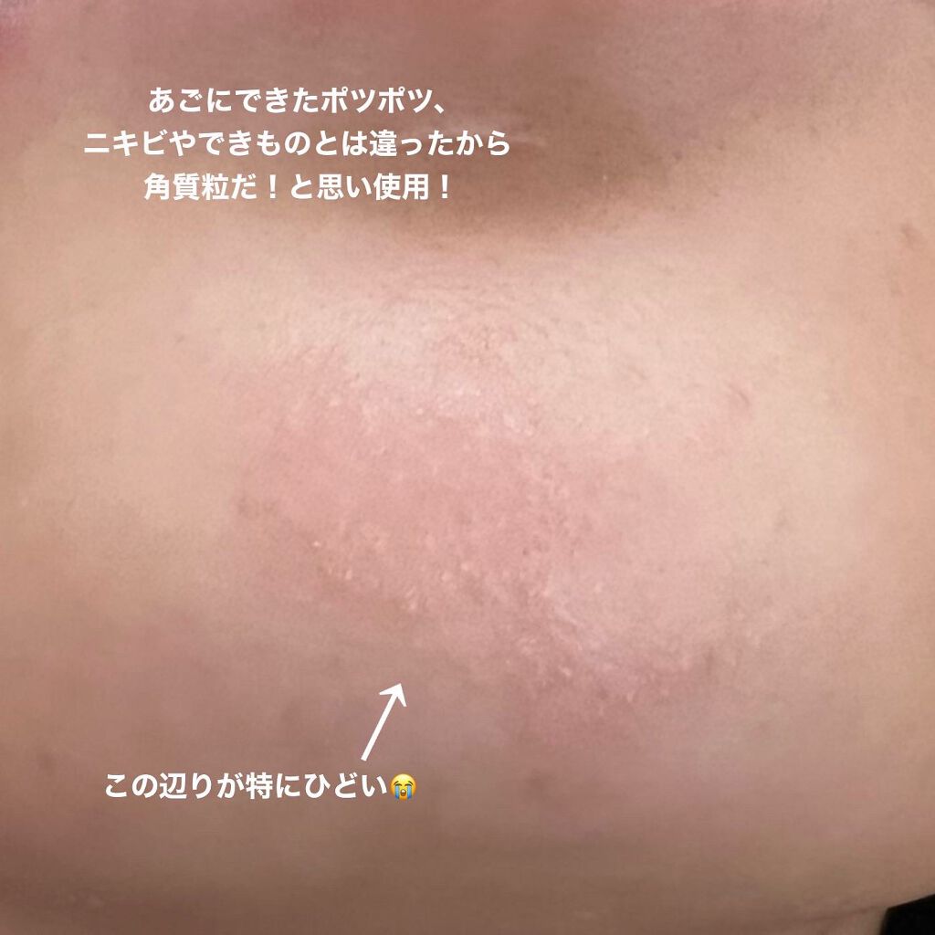 薬用ピーリングスムーサーEX/シーヴァ/ピーリングを使ったクチコミ(3枚目)