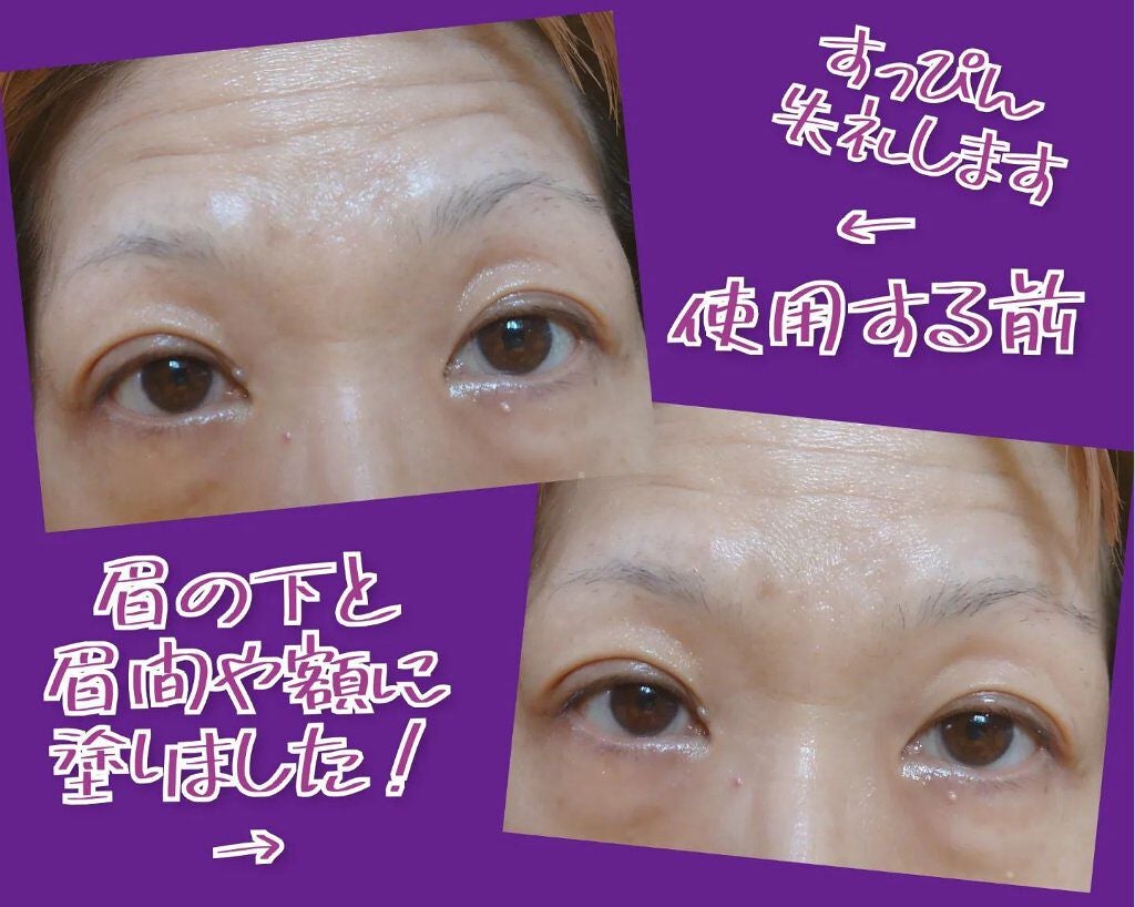 瞳子うさぎ@定期的に投稿ある方フォロバ on LIPS 「正直、美容整形を考えるくらいには、まぶたのたるみに悩んでいた瞳..」(2枚目)