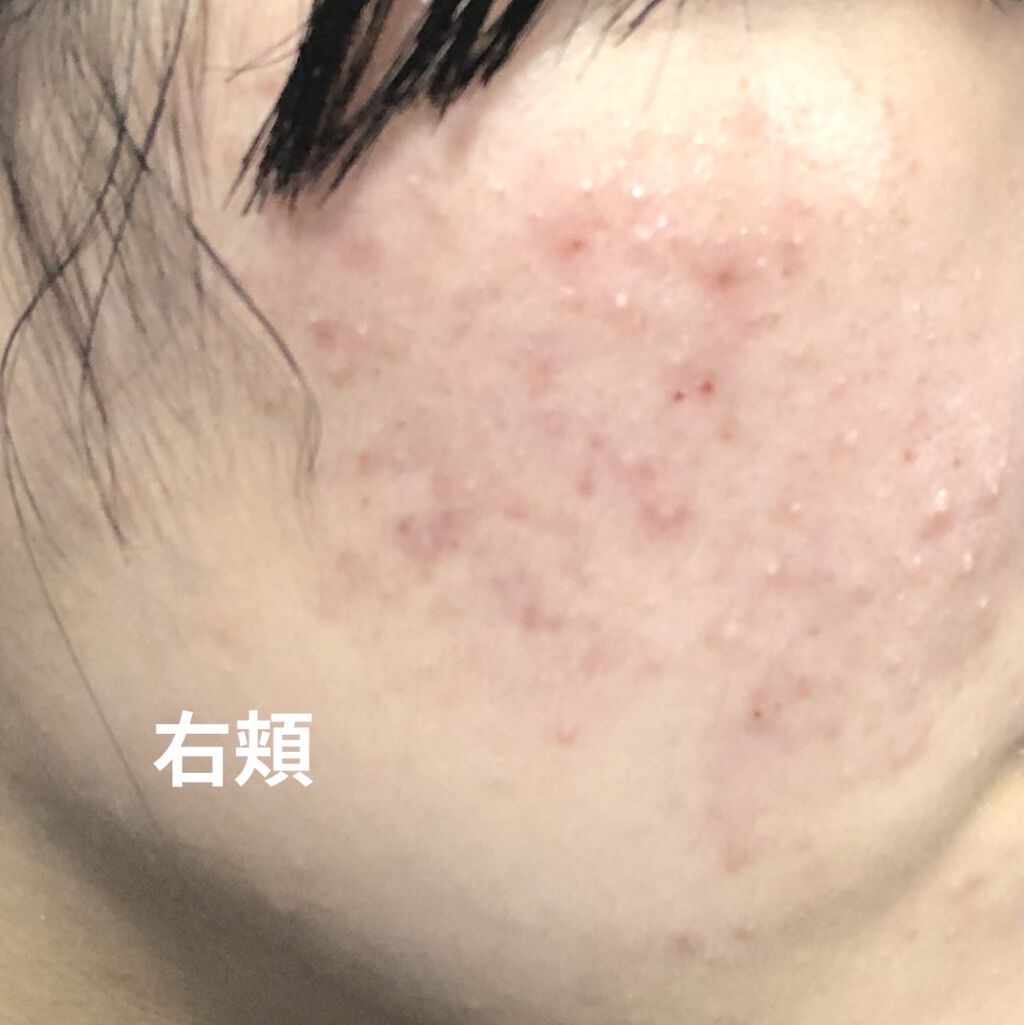 ペアアクネクリームW(医薬品)/ペア/その他を使ったクチコミ（2枚目）