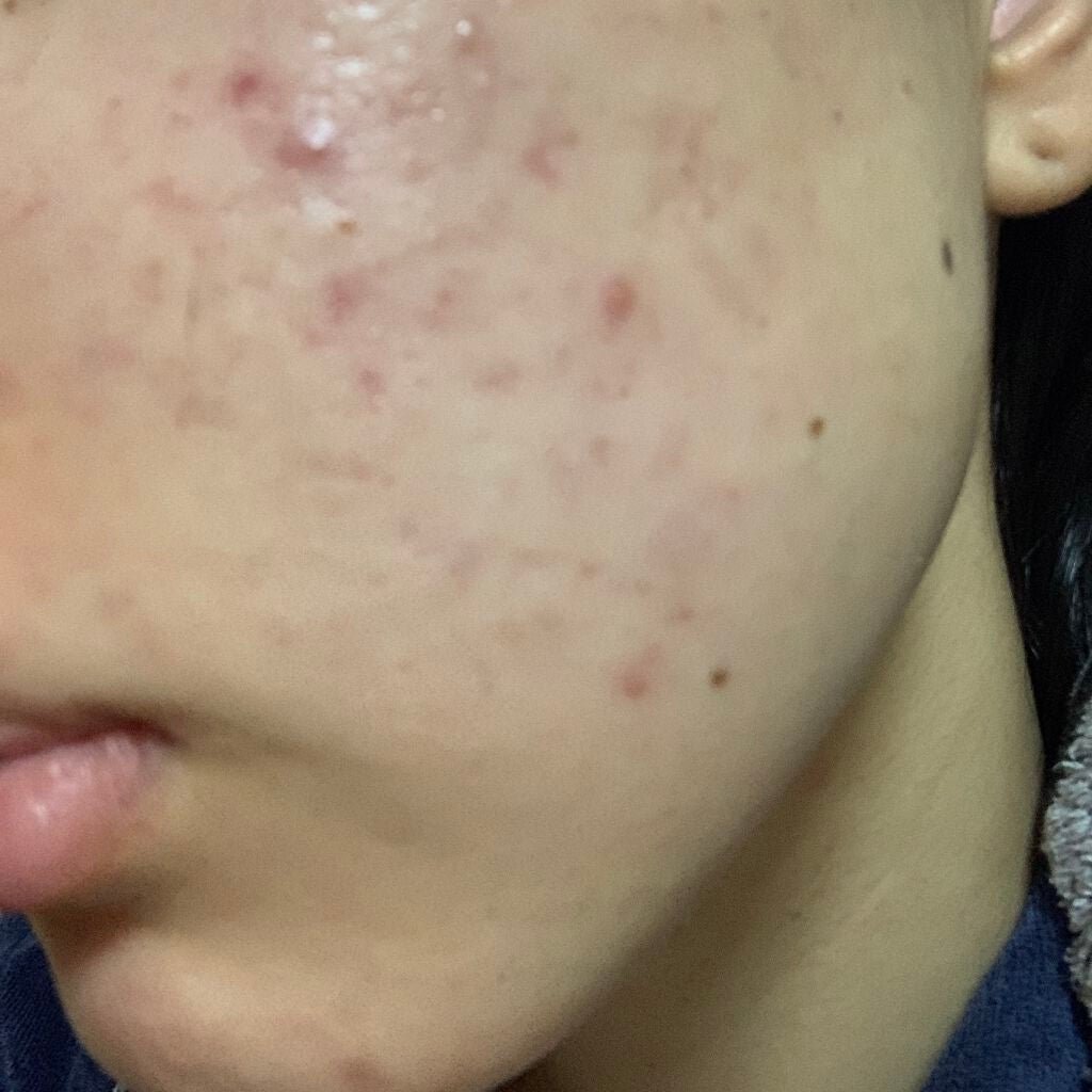 ペアアクネクリームW(医薬品)/ペア/その他を使ったクチコミ(1枚目)