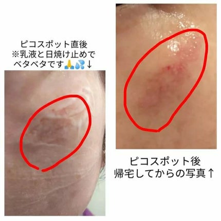 あにゃにゃ♡フォロバ100♡ on LIPS 「22日(先週日曜日)のピコスポット経過です☺️🙌場所→左頬目の..」(4枚目)