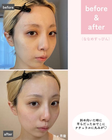 えむちゃん|3度のメシよりスキンケア on LIPS 「【おでこにヒアルロン酸入れてきた👼✨】ずっと入れたかったおでこ..」(4枚目)