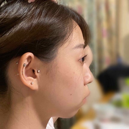 ゆいちゃんまん ᵕ̈* on LIPS 「🦷矯正記録1🦷こんにちは〜⸜🌷︎⸝ゆいちゃんまんです🦋今回の..」(4枚目)