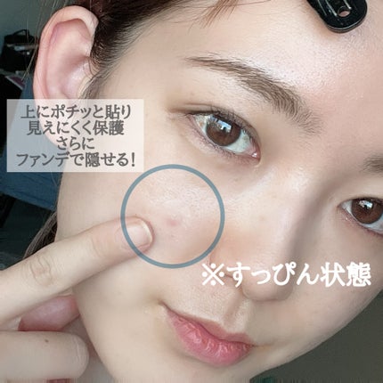 極薄透明パッチ nikipa!/金冠堂/にきびパッチを使ったクチコミ(3枚目)