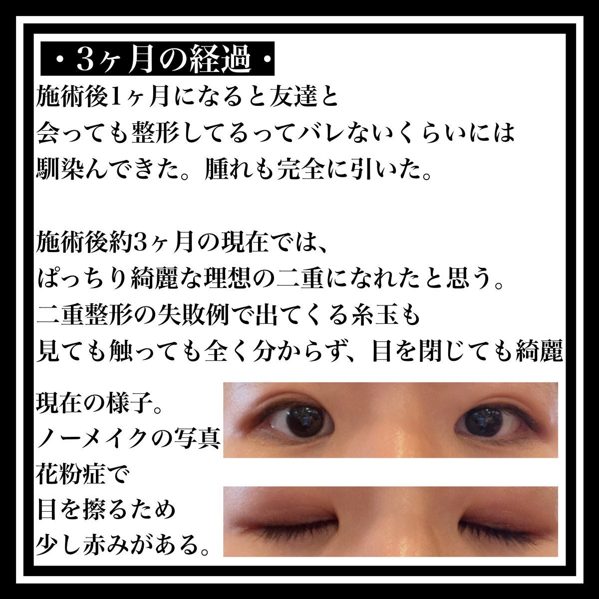 のびーるアイテープ(絆創膏タイプ、レギュラー)/DAISO/二重まぶた用アイテムを使ったクチコミ(6枚目)