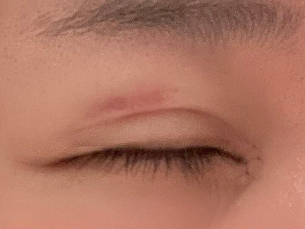 さくら。 on LIPS 「埋没法二回目、目頭切開術後5日目夜(現在)。..」(2枚目)