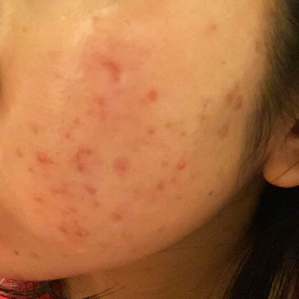 mei___47 on LIPS 「⚠️汚肌失礼します⚠️3投稿目になりました。自分ではよくなって..」(1枚目)