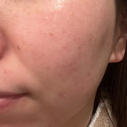 ダーマレーザー スーパーセラミド100マスク/クオリティファースト/シートマスク・パックを使ったクチコミ(5枚目)