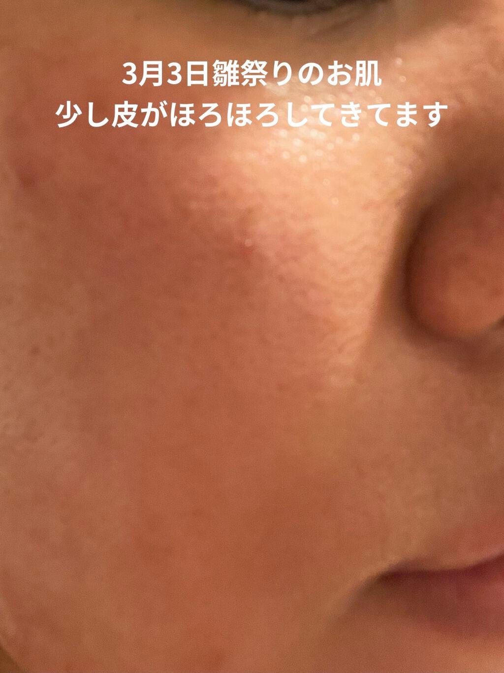 レチノールA 1% アドバンスドリバイタリゼーションクリーム/Life-flo/フェイスクリームを使ったクチコミ(5枚目)