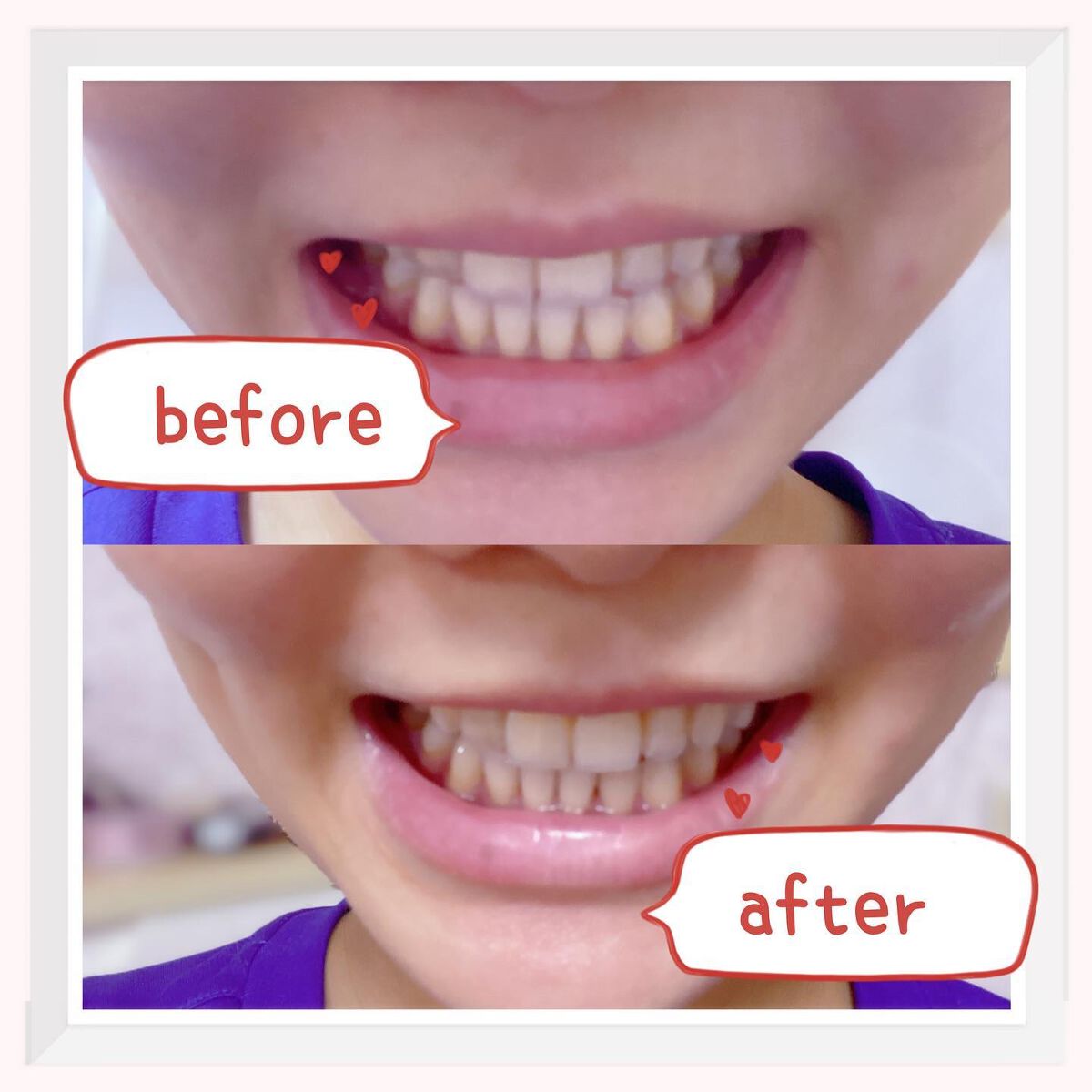 PTPハミガキ /プレビュート/歯磨き粉を使ったクチコミ（3枚目）