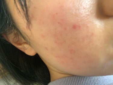 みなこ on LIPS 「ほんとに困ってます凸凹は少ないのですが赤みがすごくありますそし..」（2枚目）