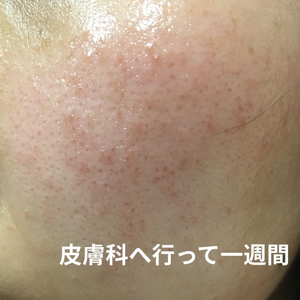 モイストバランス  ローション/ACSEINE/化粧水を使ったクチコミ（1枚目）