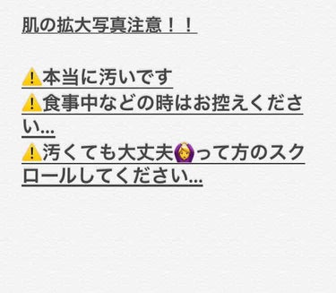 ⚠️肌の拡大画像なのでとても汚いです！⚠️
⚠️集合体恐怖症などの方は閲覧をご遠慮ください…きっと不快な気分になります⚠️

12歳のときから約5年間悩み続けた毛穴＆頬の赤みを解消してくれた神さまのよう