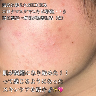 メラノCC 薬用しみ集中対策 プレミアム美容液のクチコミ「脱！！ニキビフェイス🤦🏻‍♀️🌀
プチプラスキンケア集🚰💖

1年ぶりにニキビに関する投稿✨✨.....」（1枚目）