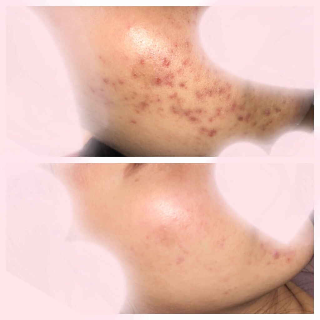 ノブ A アクネソープ/NOV/洗顔石鹸を使ったクチコミ(3枚目)