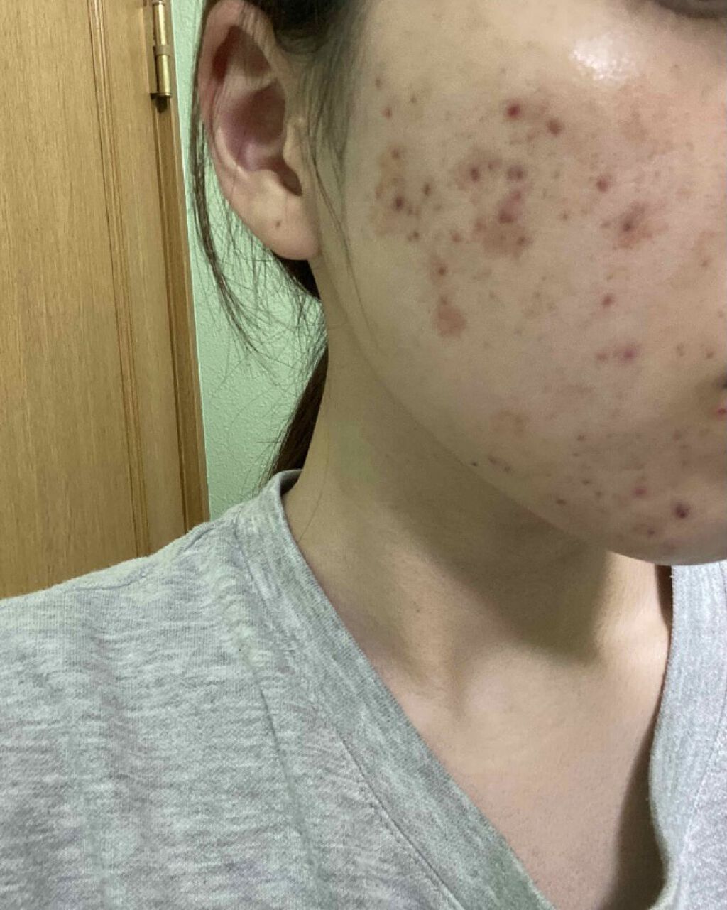 オロナインＨ軟膏 (医薬品)/オロナイン/その他を使ったクチコミ（1枚目）