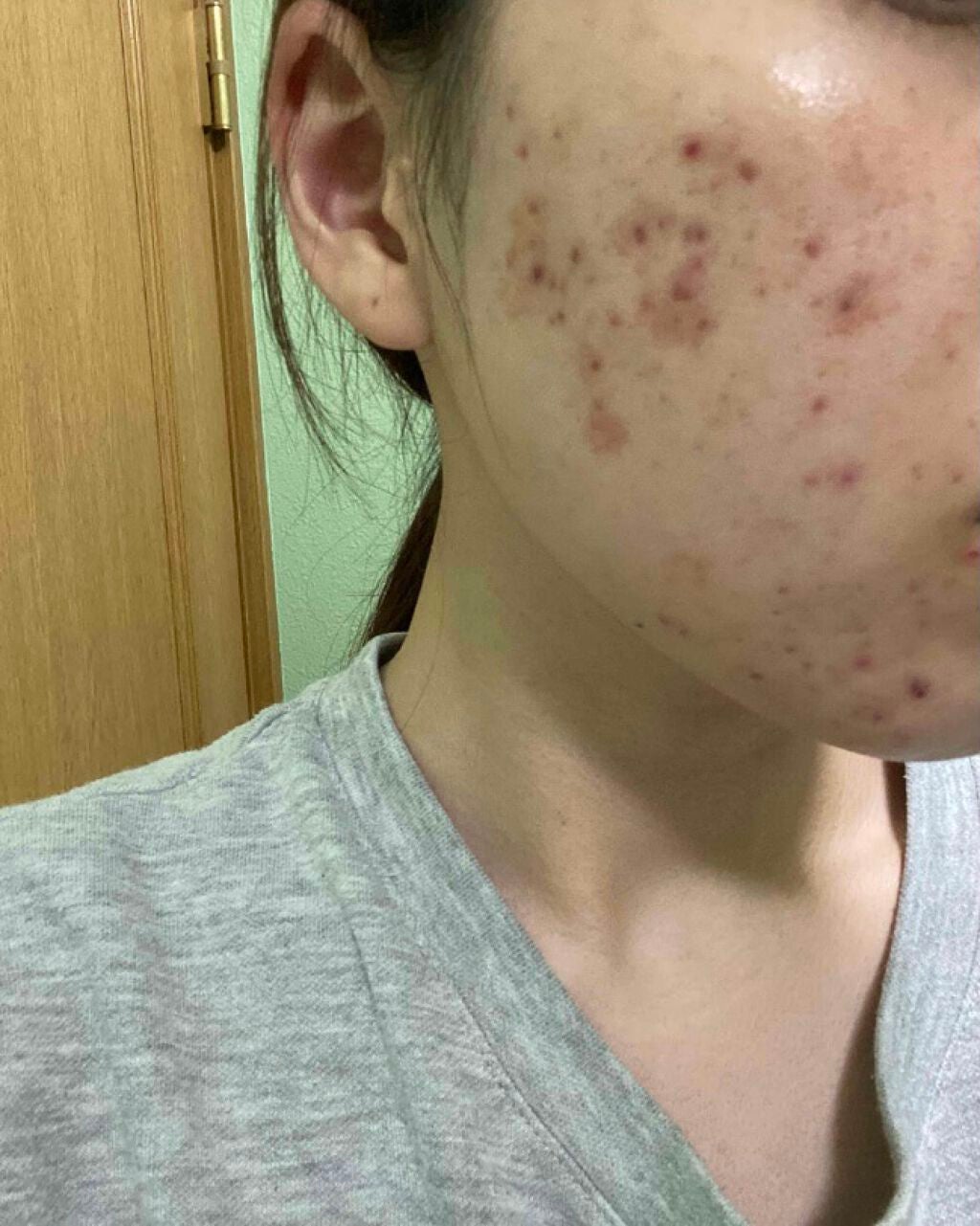 オロナインH軟膏 (医薬品)/オロナイン/その他を使ったクチコミ(1枚目)