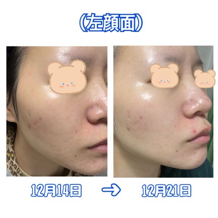 白潤 薬用美白化粧水(しっとりタイプ)/肌ラボ/化粧水を使ったクチコミ(3枚目)