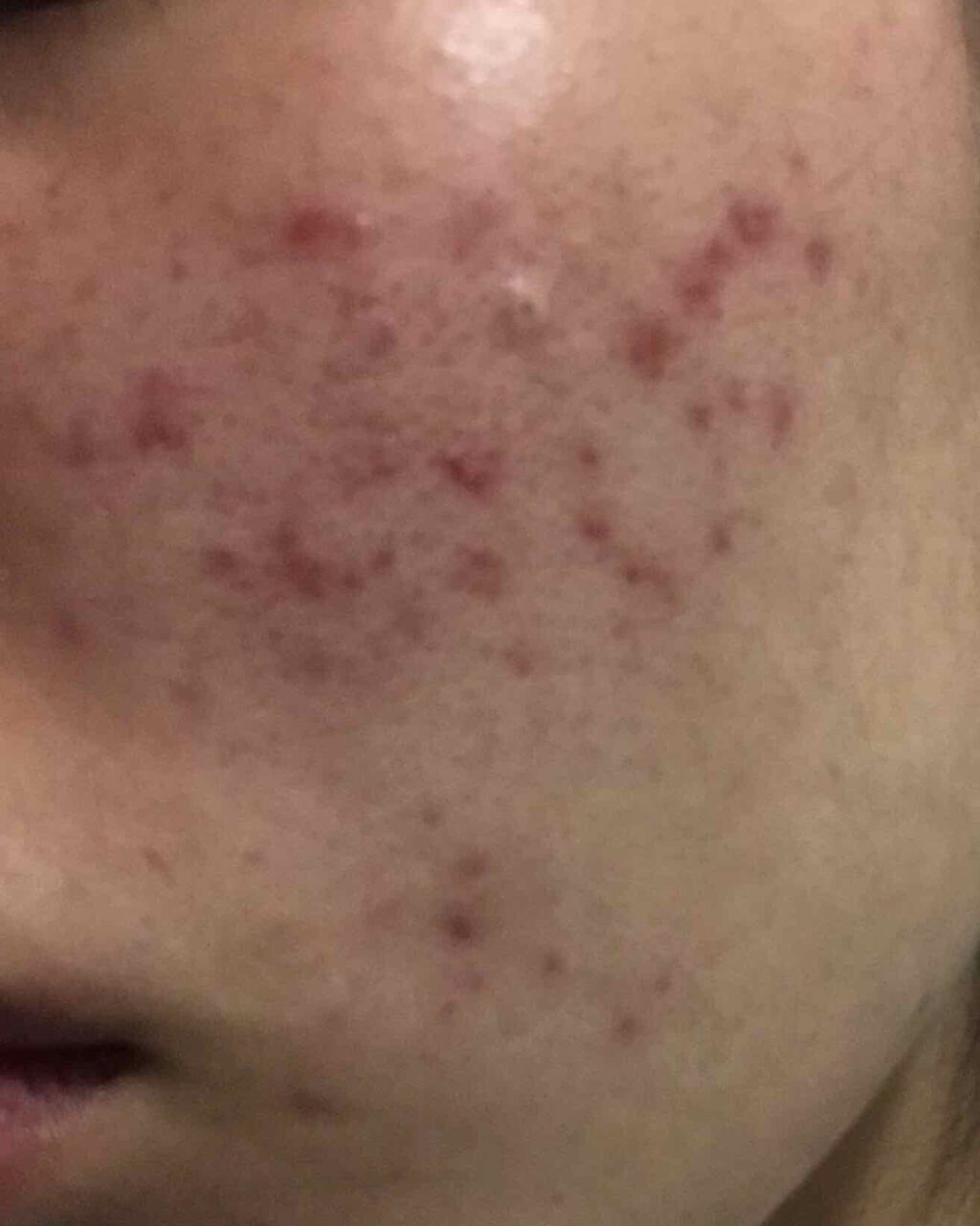 き on LIPS 「ニキビめも..」(1枚目)