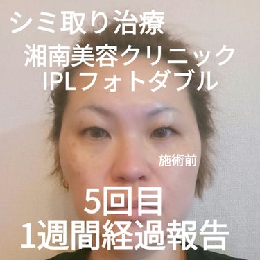 ビヨンセ奥二重向上委員長🥸LIPSパートナー🥳 on LIPS 「湘南美容クリニックで5回目のIPLシミ取り治療をしてきました！..」（1枚目）