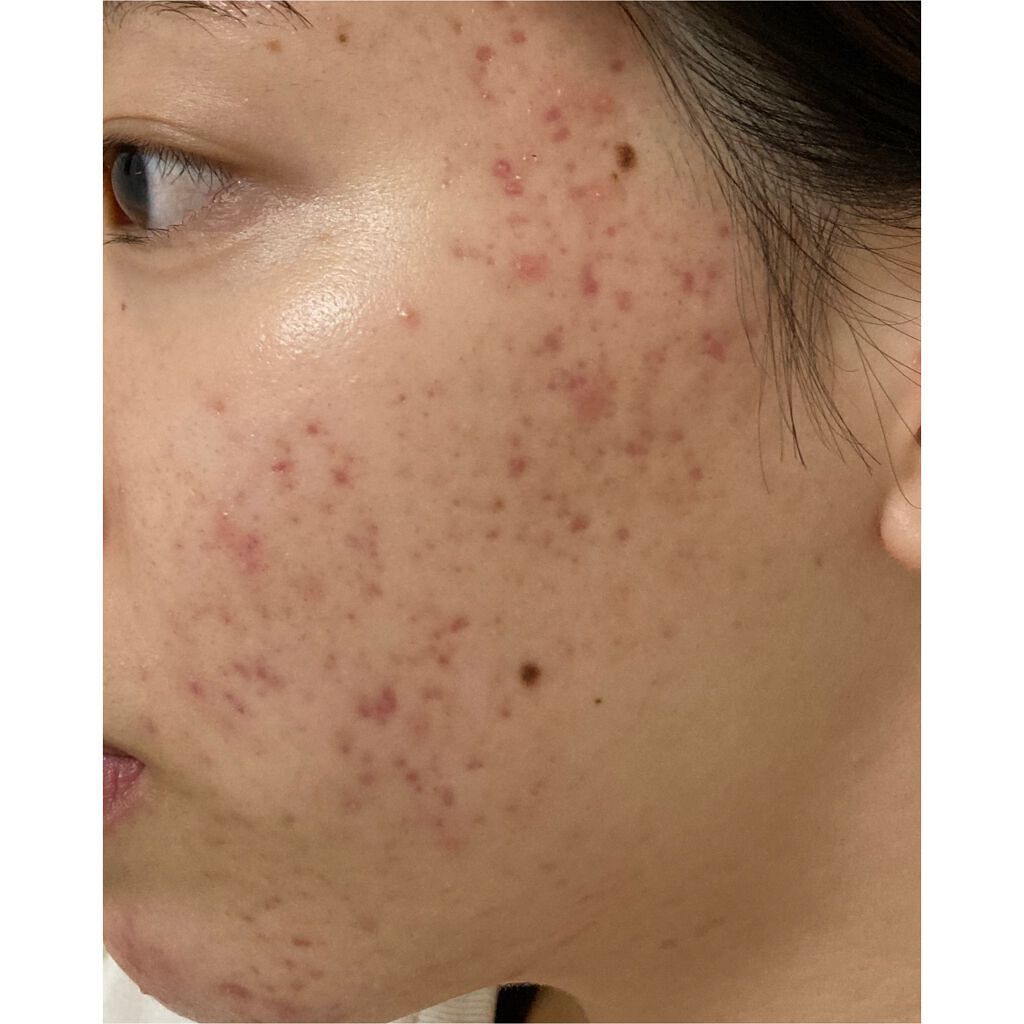 ニキビあとケアジェル/アットノン/その他スキンケアを使ったクチコミ(1枚目)