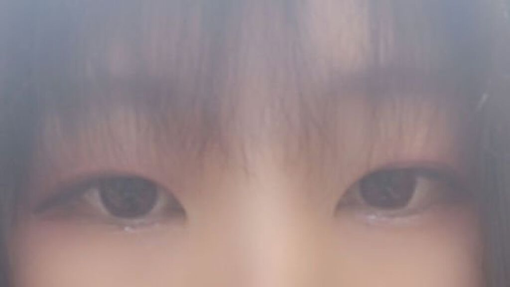 二重整形/その他を使ったクチコミ（2枚目）