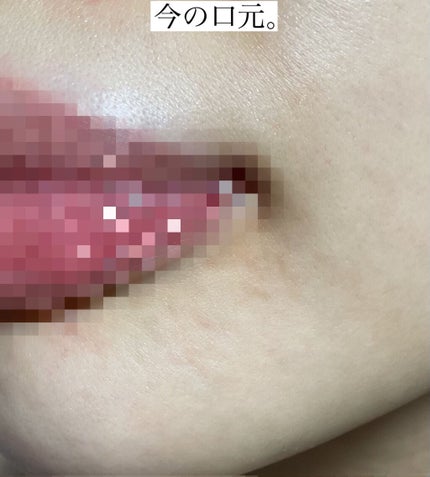 清上防風湯 セイジョウボウフウトウ(医薬品)/ツムラ/その他を使ったクチコミ(3枚目)