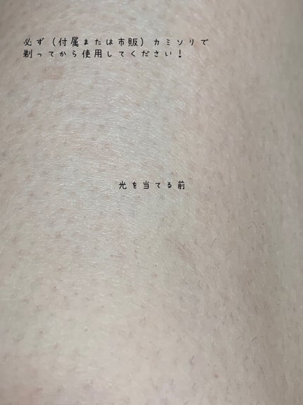 光脱毛器 VIO/Sarlisi/家庭用脱毛器を使ったクチコミ(5枚目)