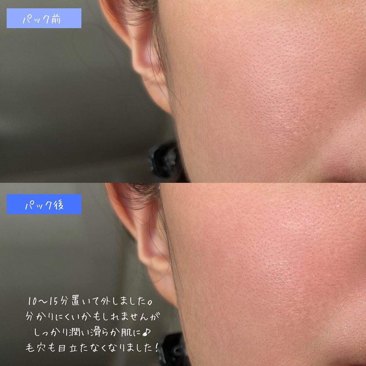 SUIKO HC ビタミン5エッセンスマスク/SUIKO HATSUCURE/シートマスク・パックを使ったクチコミ(5枚目)