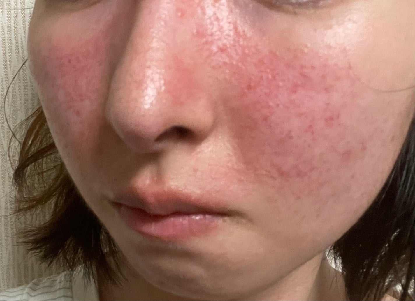 Mikaringo on LIPS 「前回の皮膚科受診から20日経ちました🍀酒さについて自分なりに調..」(3枚目)