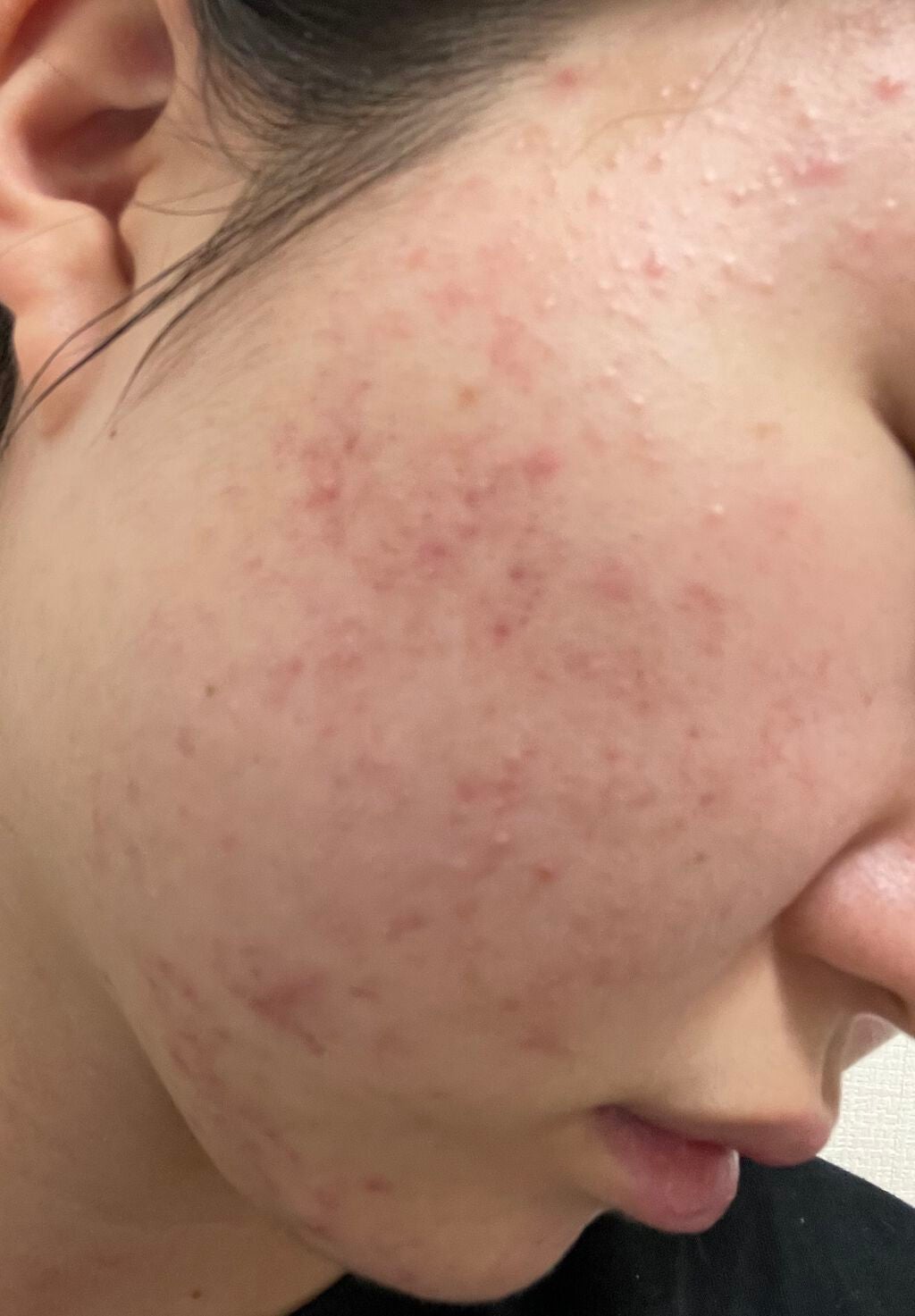 バイオイル/バイオイル/フェイスオイルを使ったクチコミ(2枚目)