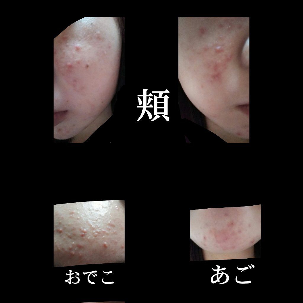 こんにちは on LIPS 「過去最高に肌荒れ中です、、、。朝☀水洗顔→ヘパリン→ヒルドイド..」(2枚目)