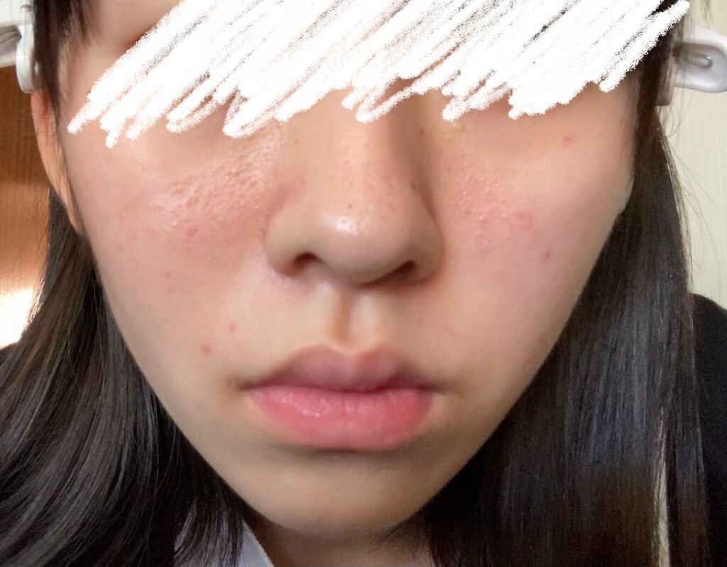 オードムーゲ 薬用ローション(ふきとり化粧水)/オードムーゲ/拭き取り化粧水を使ったクチコミ(5枚目)