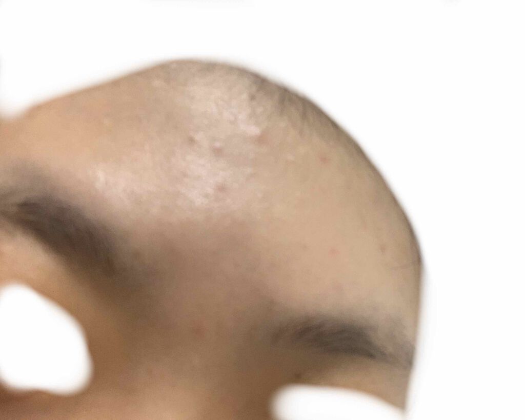 ぬぬ on LIPS 「2日目カメラで撮ると余計目立つなかなか治らないほぼ毎日同じよう..」(4枚目)