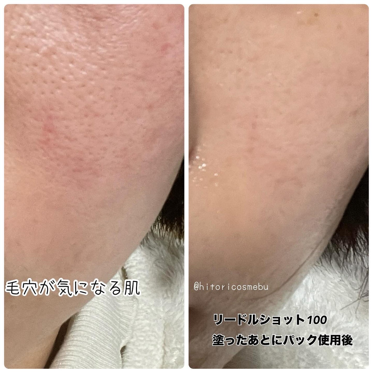 リードルショット100/VT/美容液を使ったクチコミ(2枚目)