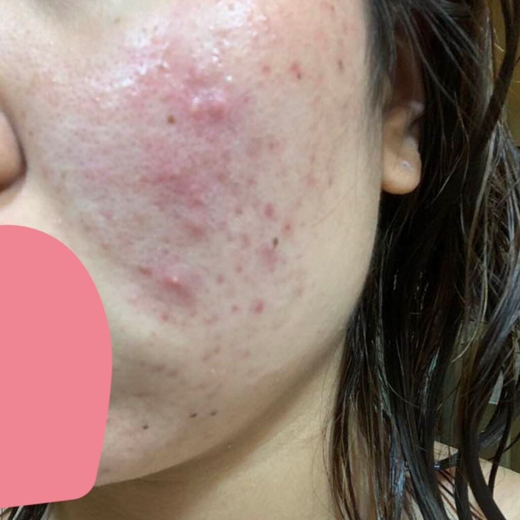 pink_lips_m6cr on LIPS 「閲覧注意肌の画像あります。2021.10➡2022.6の画像に..」(2枚目)