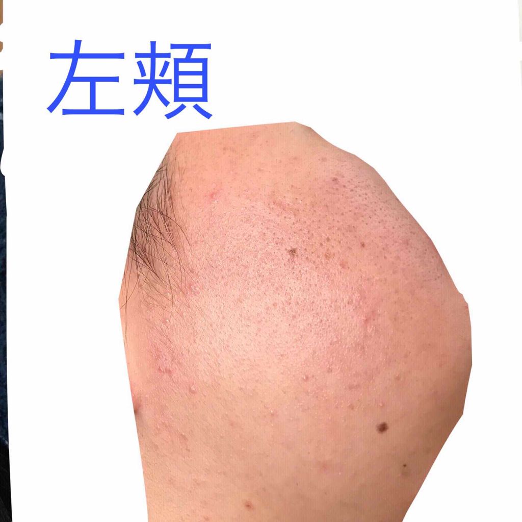 るい on LIPS 「高校3年生女子です。約1ヶ月オードムーゲの洗顔を使い、今は青色..」(4枚目)