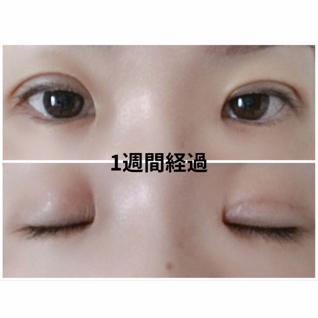 二重整形/その他を使ったクチコミ（3枚目）