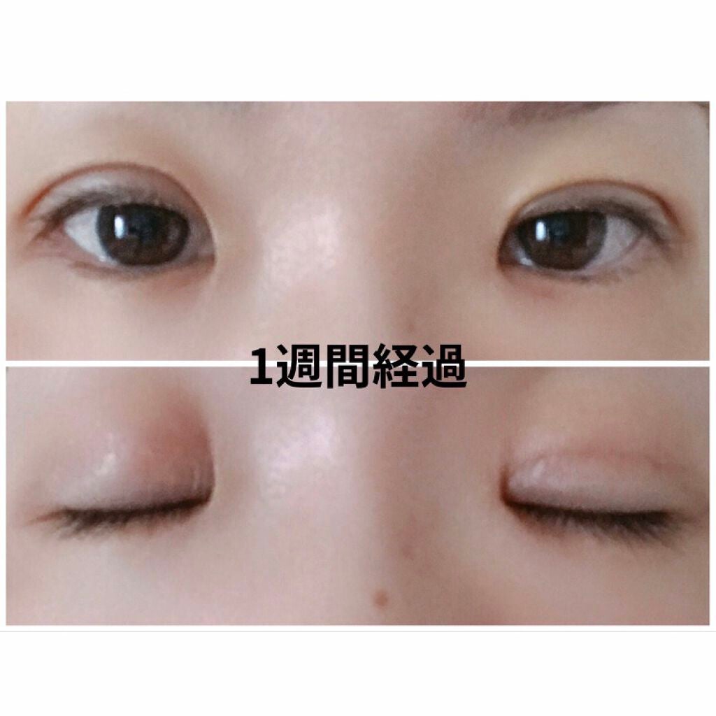 yuu.cosme25 on LIPS 「【施術を決意するまでの小話】※注意※2枚目以降画像ありです!初..」(3枚目)