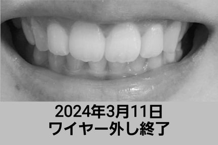 デンタルラボ マウスピース・矯正用リテーナー用洗浄剤/アース製薬/その他オーラルケアを使ったクチコミ(8枚目)