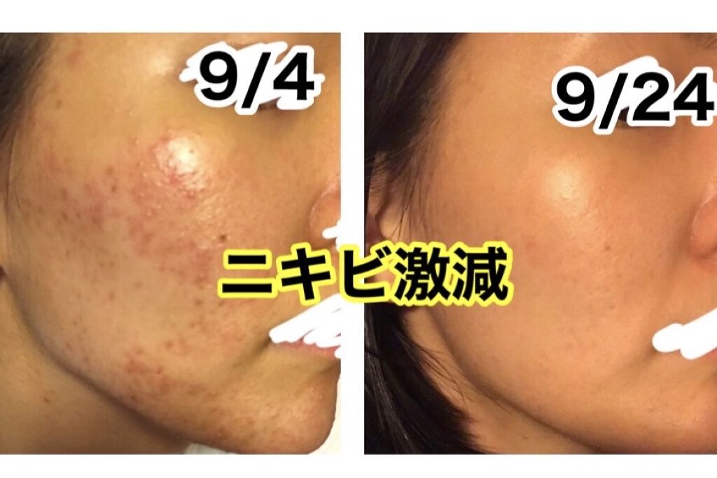 明色美顔水 薬用化粧水/美顔/化粧水を使ったクチコミ（1枚目）