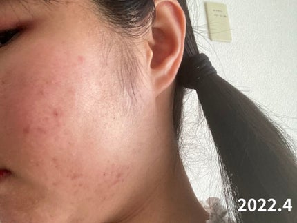 薬用しみ集中対策 プレミアム美容液/メラノCC/美容液を使ったクチコミ(3枚目)