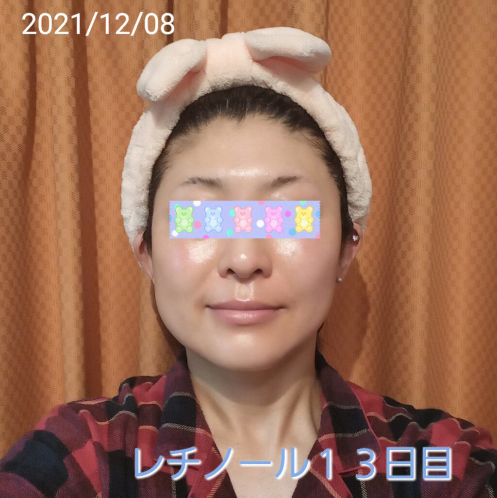 トレチノインジェル/A-Ret/美容液を使ったクチコミ（1枚目）