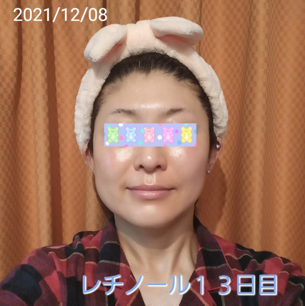 トレチノインジェル/A-Ret/美容液を使ったクチコミ(1枚目)