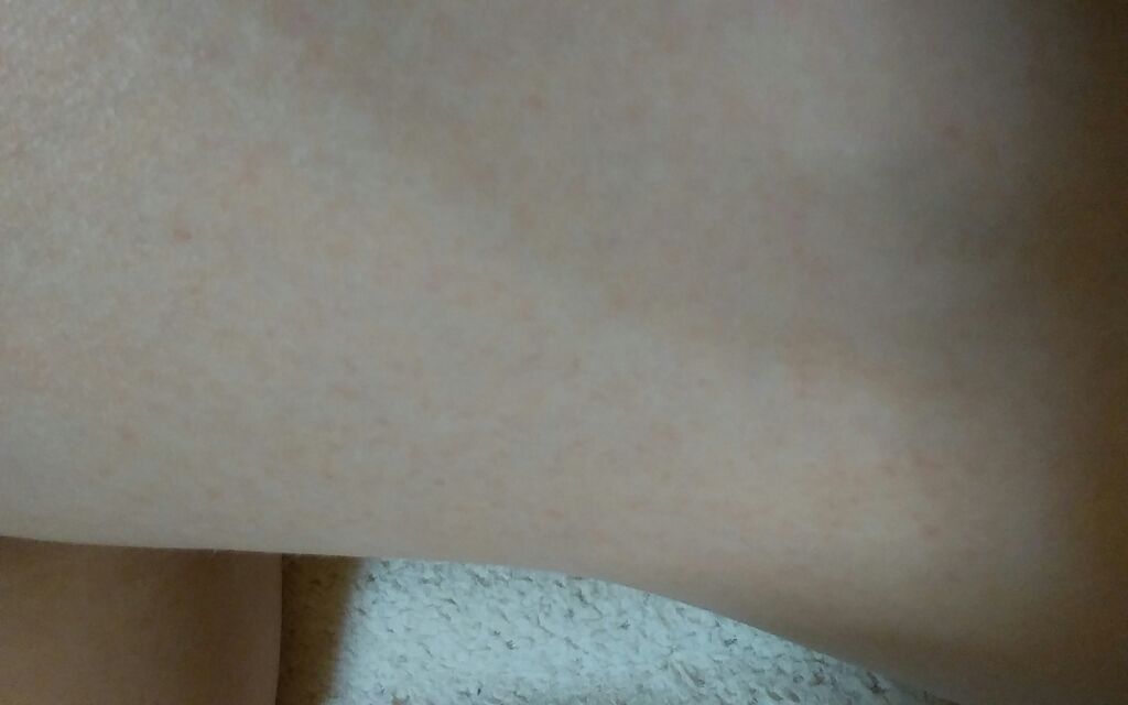 ko_ha. on LIPS 「皆さん2枚目からの画像は私の足なのですが、太ももに赤っぽい色も..」(2枚目)